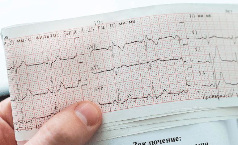 Tratamiento de taquicardia ventricular en Naucalpan: Avances en Cardiología y Electrofisiología